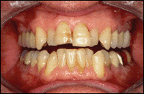 teeth whitening dentist taunton ma before