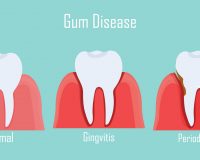 The Causes of Gum Disease