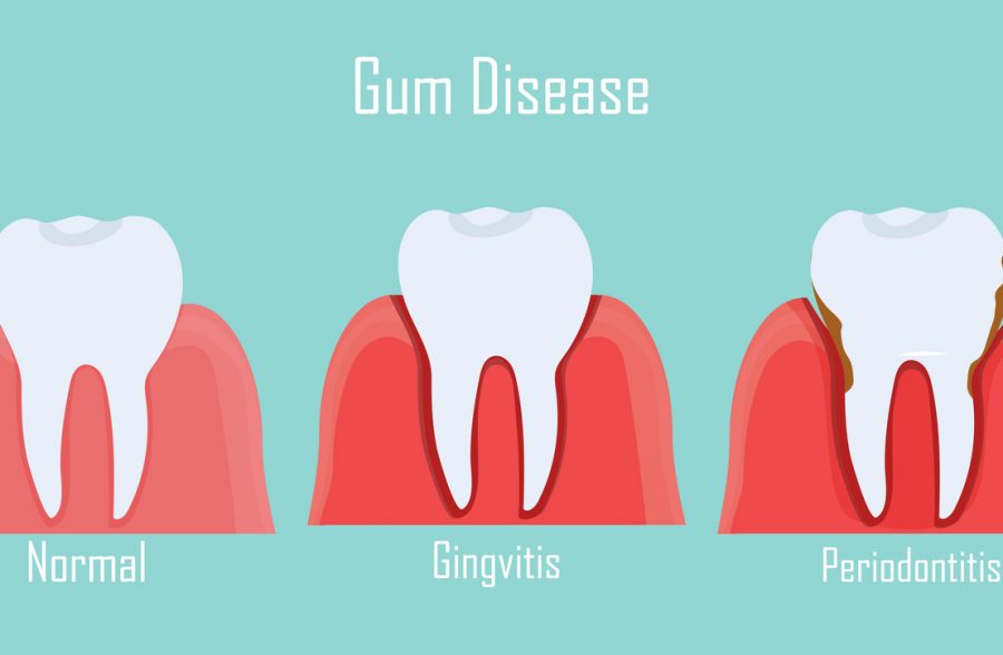 Teeth infographic Gum disease stages gingivitis and periodontitis. Editable vector illustration in flat style. Medical concept in natural colors on background. Keep your teeth healthy Taunton MA Dentist