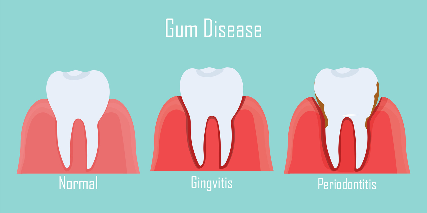 The Causes Of Gum Disease Mark R Turner Dds
